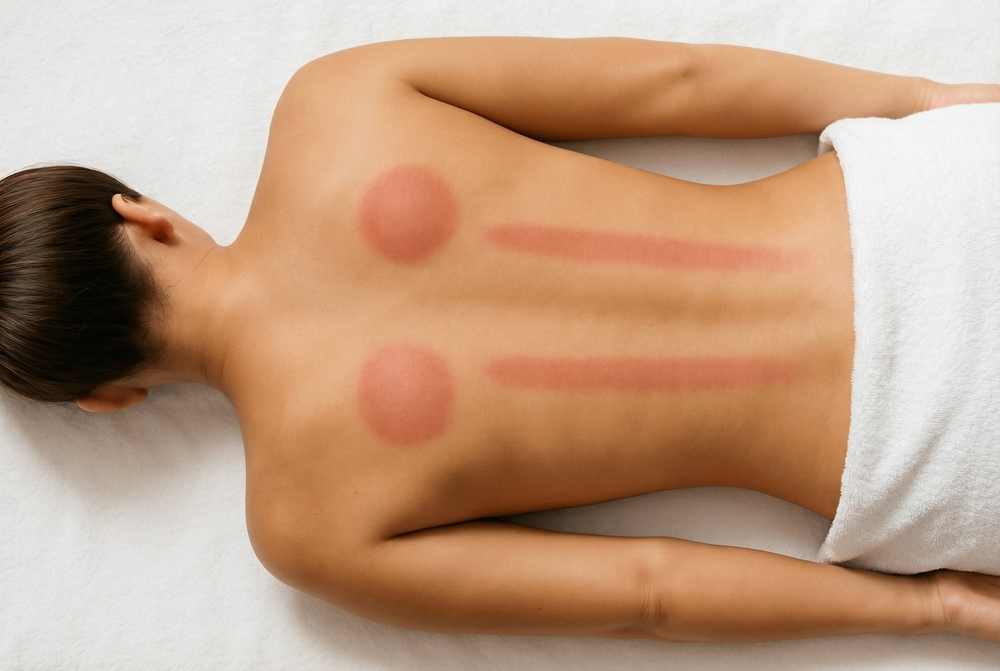 Woman after using the Dahliora cupping device. Noticeable redness because of the relief and benefits of the product. White spa environment.
